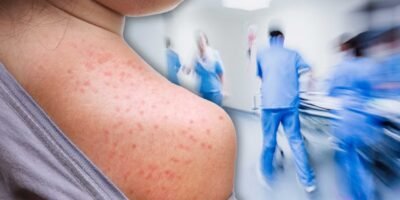 Confirma Salud estatal tres casos de sarampión en Ciudad Insurgentes